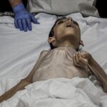 «سوء تغذیه کودکان غزه»؛ ۵۷ کودک در بحران غزه شهید شدند