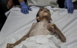 «سوء تغذیه کودکان غزه»؛ ۵۷ کودک در بحران غزه شهید شدند
